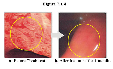 MEBO HBRRS - CLINICAL APPLICATION for Gastrointestinal regeneration I