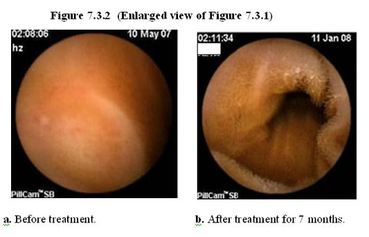 MEBO HBRRS - CLINICAL APPLICATION for Gastrointestinal regeneration II